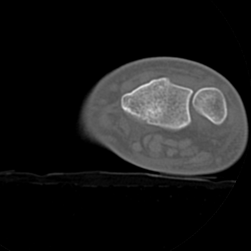 File:Carpo-metacarpal fracture-dislocations with hamatum split fracture (Radiopaedia 18482-18343 Axial bone window 31).jpg