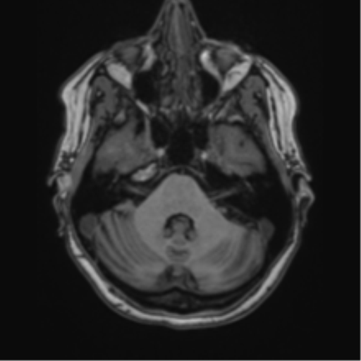 Cavernoma with bleed - midbrain (Radiopaedia 54546-60774 Axial T1 2).png