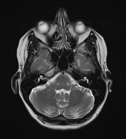 File:Cavernoma with bleed - midbrain (Radiopaedia 54546-60774 Axial T2 6).png
