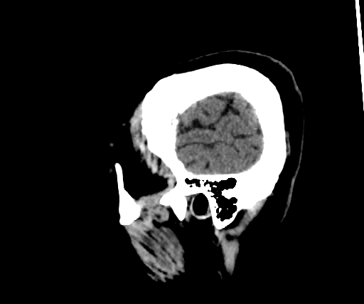 Cavernous hemangioma of the cerebellar falx (Radiopaedia 73025-83723 B 39).jpg