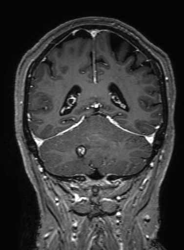 Cavernous hemangioma of the cerebellar falx (Radiopaedia 73025-83724 Coronal T1 C+ 268).jpg