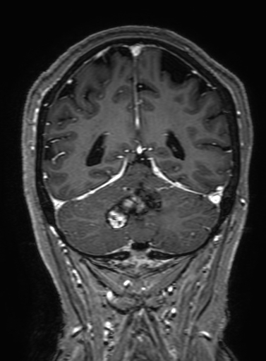 Cavernous hemangioma of the cerebellar falx (Radiopaedia 73025-83724 Coronal T1 C+ 278).jpg