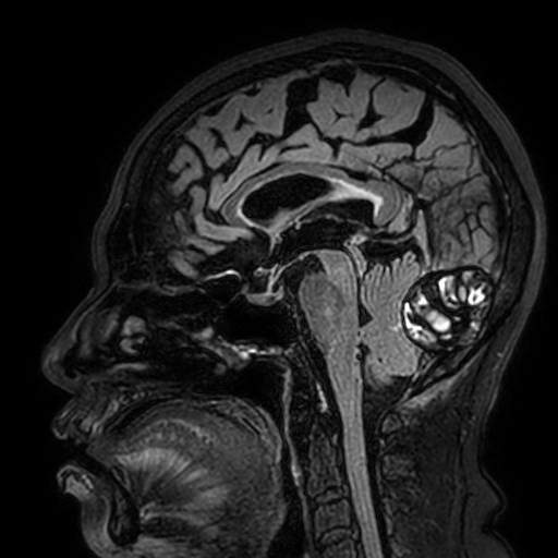 File:Cavernous hemangioma of the cerebellar falx (Radiopaedia 73025-83724 Sagittal FLAIR 107).jpg