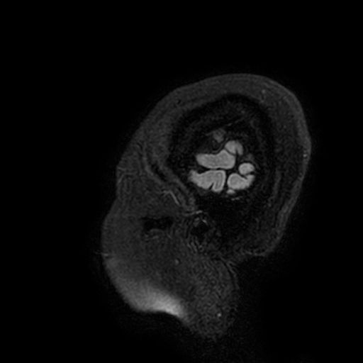 Cavernous hemangioma of the cerebellar falx (Radiopaedia 73025-83724 Sagittal FLAIR 214).jpg
