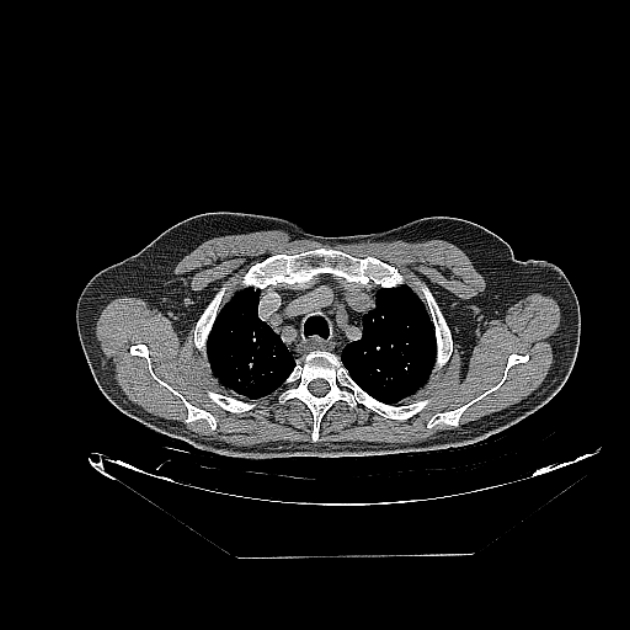 Cavitating bronchogenic carcinoma (Radiopaedia 44489-48162 Axial non-contrast 11).jpg