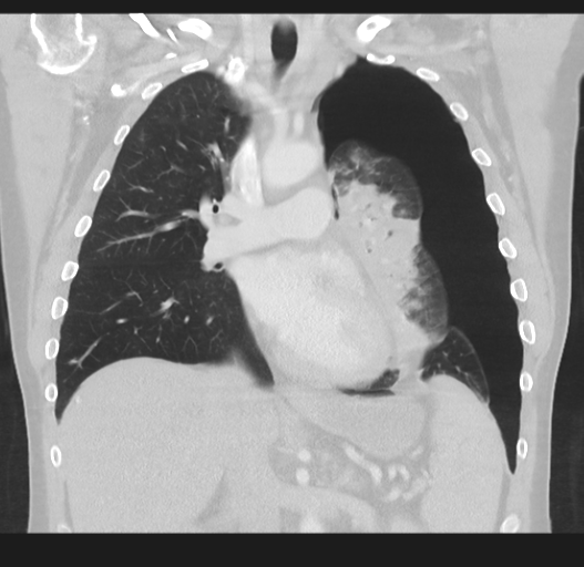 Cavitating pneumonia complicated by pneumothorax (Radiopaedia 48149-52994 Coronal lung window 29).png