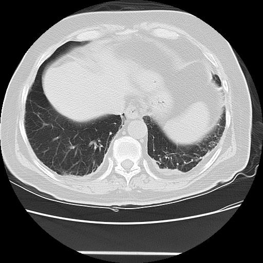 Cavitating pulmonary metastases (Radiopaedia 89545-106544 Axial lung window 45).jpg