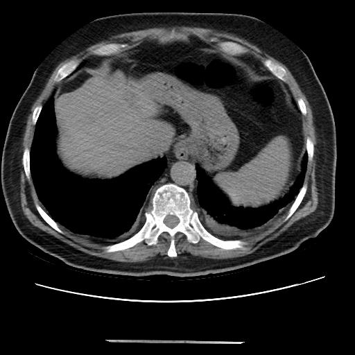 File:Cavitating pulmonary metastases (Radiopaedia 89545-106544 Axial non-contrast 47).jpg
