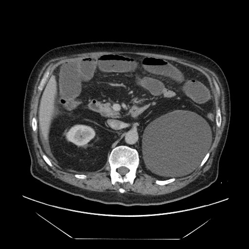 Cecal adenocarcinoma (Radiopaedia 64871-73817 A 31).jpg