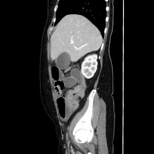 Cecal adenocarcinoma (Radiopaedia 75909-87331 C 22).jpg
