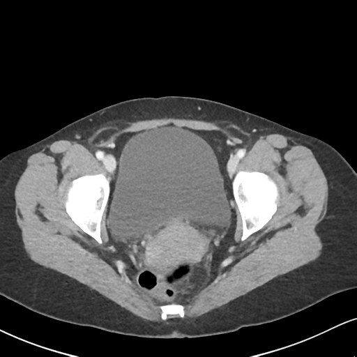 Cecal internal hernia through the foramen of Winslow (Radiopaedia 44820-48651 B 70).png
