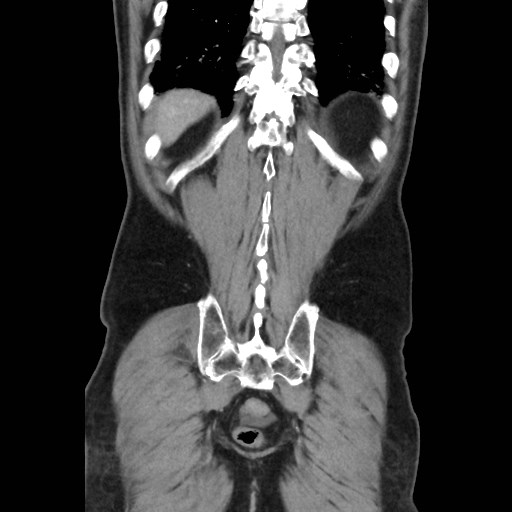 File:Cecal mass causing appendicitis (Radiopaedia 59207-66531 B 45).jpg