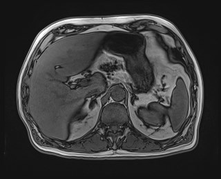 Cecal mass causing appendicitis (Radiopaedia 59207-66532 D 40).jpg