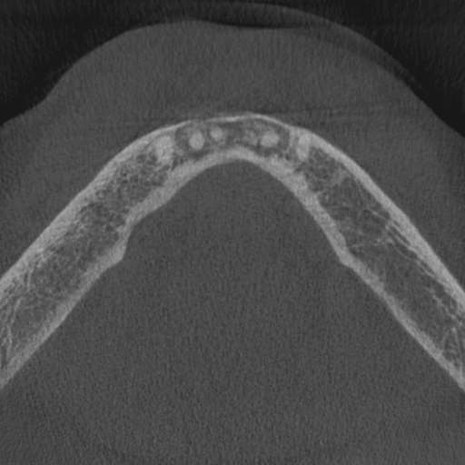 Cemento-osseous dysplasia (Radiopaedia 48251-53126 Axial non-contrast 18).jpg