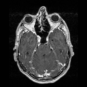 Central-variant posterior reversible encephalopathy syndrome (PRES) (Radiopaedia 43880-47358 Axial T1 C+ 44).jpg