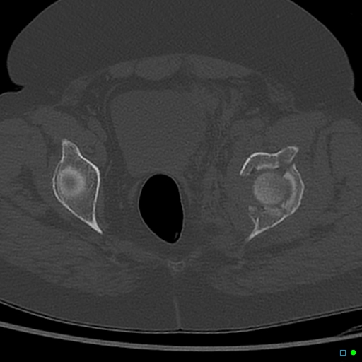 Central fracture-dislocation of the acetabulum (Radiopaedia 36578-38150 Axial bone window 54).jpg