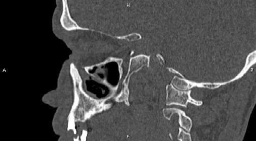 File:Central giant cell granuloma (Radiopaedia 83346-97761 Sagittal bone window 30).jpg