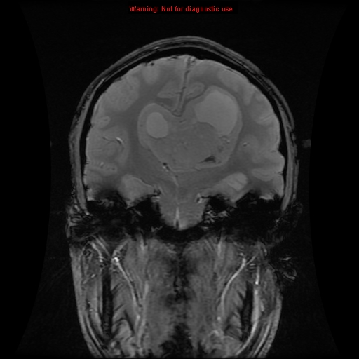 File:Central neurocytoma (Radiopaedia 13188-13206 G 7).jpg