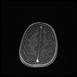 Central neurocytoma (Radiopaedia 30220-30842 Axial T1 C+ 124).jpg