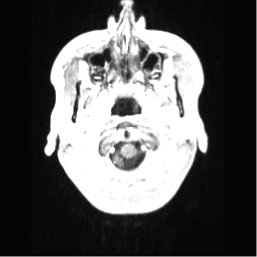 File:Central neurocytoma (Radiopaedia 37664-39557 Axial T1 C+ 7).png