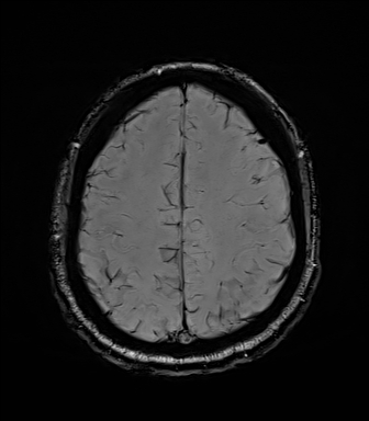 File:Central neurocytoma (Radiopaedia 71068-81303 Axial SWI 50).jpg
