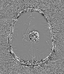 File:Central neurocytoma (Radiopaedia 84497-99872 Axial 47).jpg