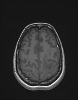 Central neurocytoma (Radiopaedia 84497-99872 Axial T1 154).jpg