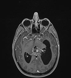 Central neurocytoma (Radiopaedia 84497-99872 Axial T1 C+ 69).jpg
