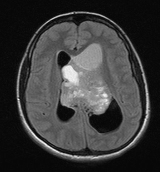 File:Central neurocytoma (Radiopaedia 9497-10178 Axial FLAIR 1).jpg