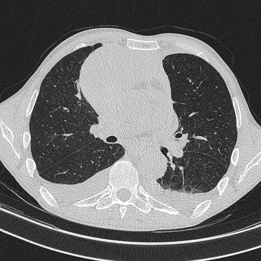 Central venous catheter tip extravasation (Radiopaedia 82828-97113 Axial lung window 42).jpg
