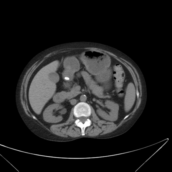 Centrilobular pulmonary emphysema (Radiopaedia 24495-24789 Axial non-contrast 53).jpg