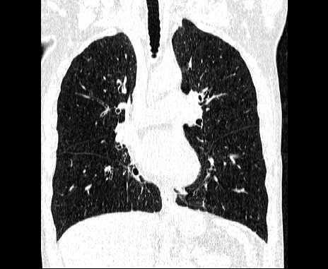 Centrilobular pulmonary emphysema (Radiopaedia 62468-70718 Coronal lung window 35).jpg