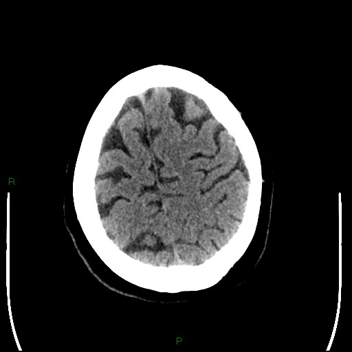 Cerebellar abscess (Radiopaedia 78135-90671 Axial non-contrast 91).jpg