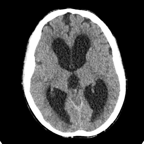 Cerebellar abscess secondary to mastoiditis (Radiopaedia 26284-26412 Axial non-contrast 78).jpg