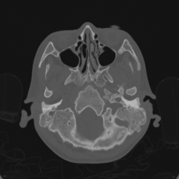 Cerebellar abscess secondary to mastoiditis (Radiopaedia 26284-26413 Axial bone window 28).jpg