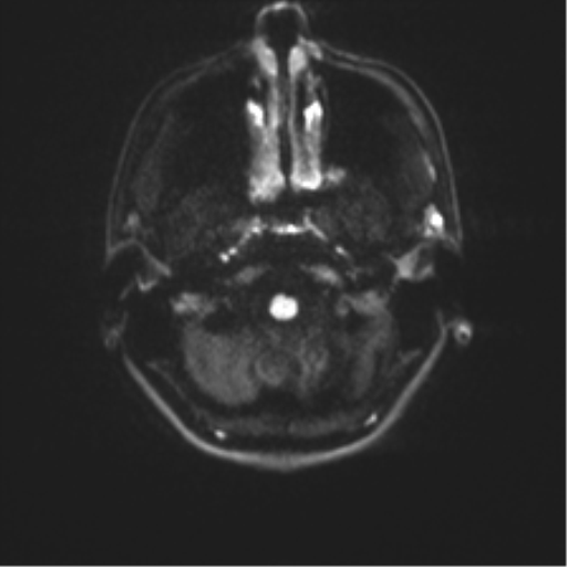 Cerebellar agenesis with hypoplastic pons (pontocerebellar hypoplasia) (Radiopaedia 57224-64138 Axial DWI 42).png