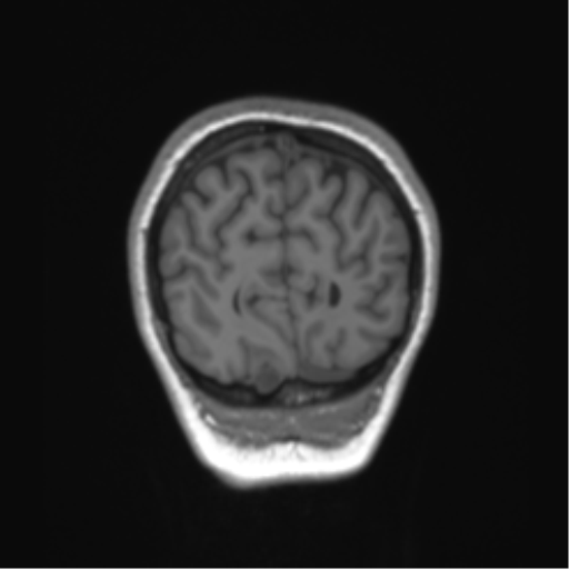 Cerebellar agenesis with hypoplastic pons (pontocerebellar hypoplasia) (Radiopaedia 57224-64138 Coronal T1 17).png