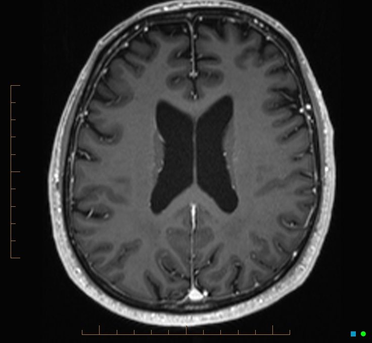 Cerebellar gangliocytoma (Radiopaedia 65377-74422 Axial T1 C+ 85).jpg