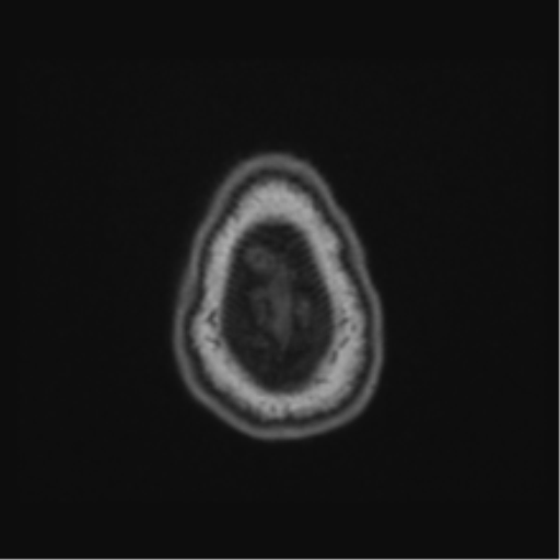 File:Cerebellar hemangioblastomas and pituitary adenoma (Radiopaedia 85490-101176 Axial T1 70).png