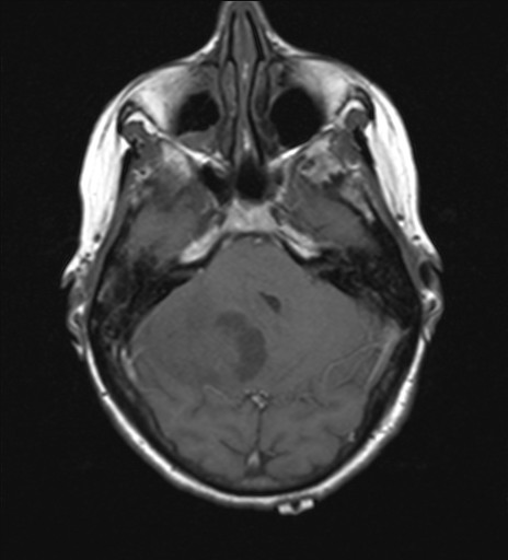 File:Cerebellar metastases (Radiopaedia 24038-24249 Axial T1 12).jpg