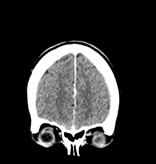 Cerebellar metastases - colorectal adenocarcinoma (Radiopaedia 40947-43652 Coronal C+ 19).png
