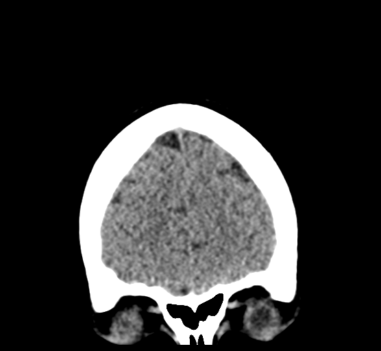 Cerebellar metastases - colorectal adenocarcinoma (Radiopaedia 40947-43652 Coronal non-contrast 18).png