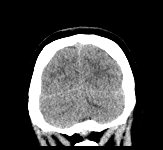 Cerebellar metastases - colorectal adenocarcinoma (Radiopaedia 40947-43652 Coronal non-contrast 81).png