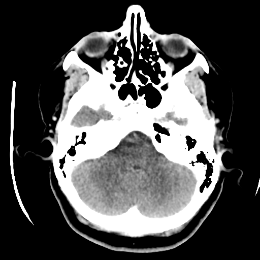 Cerebellar metastasis (cystic appearance) (Radiopaedia 41395-44258 B 12).png
