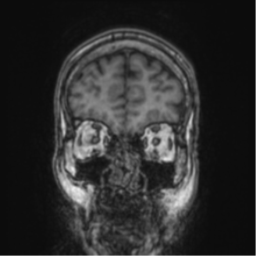 Cerebellar metastasis from lung adenocarcinoma (Radiopaedia 86690-102829 Coronal T1 83).png