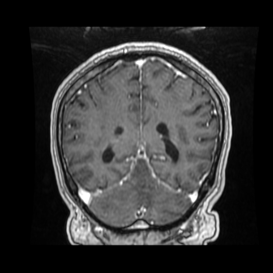 Cerebellar metastasis of pulmonary adenocarcinoma, cavernous venous malformation, and developmental venous anomaly (Radiopaedia 85827-101661 Coronal T1 C+ 35).jpg