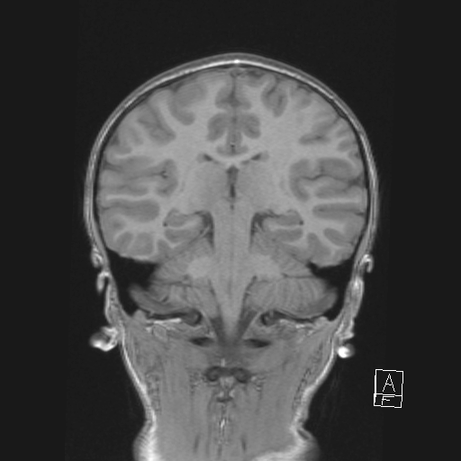 File:Cerebellar stroke (Radiopaedia 32202-33150 Coronal T1 36).png