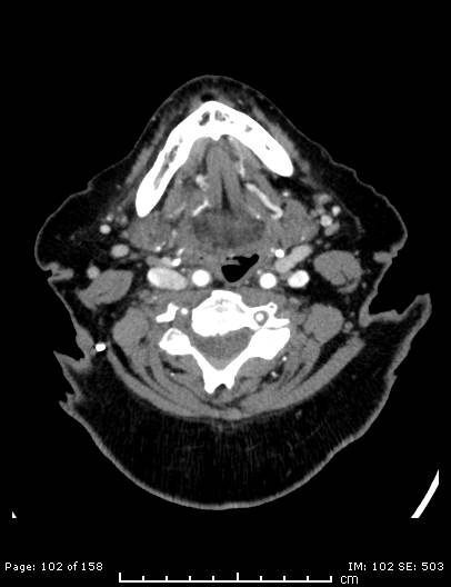 Cerebellar strokes due to intracranial giant cell arteritis (Radiopaedia 68799-78510 CT angiogram 102).jpg
