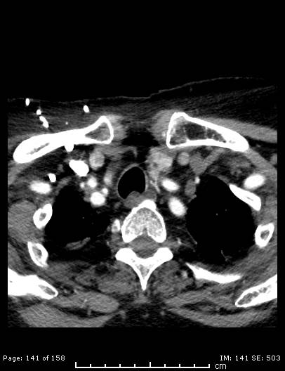 Cerebellar strokes due to intracranial giant cell arteritis (Radiopaedia 68799-78510 CT angiogram 141).jpg