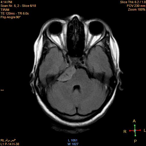 File:Cerebellopontine angle meningioma (Radiopaedia 22488-22525 Axial FLAIR 4).jpg